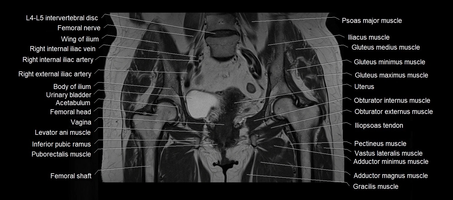 MRI 3T pelvis coronal cross section anatomy image 14.webp